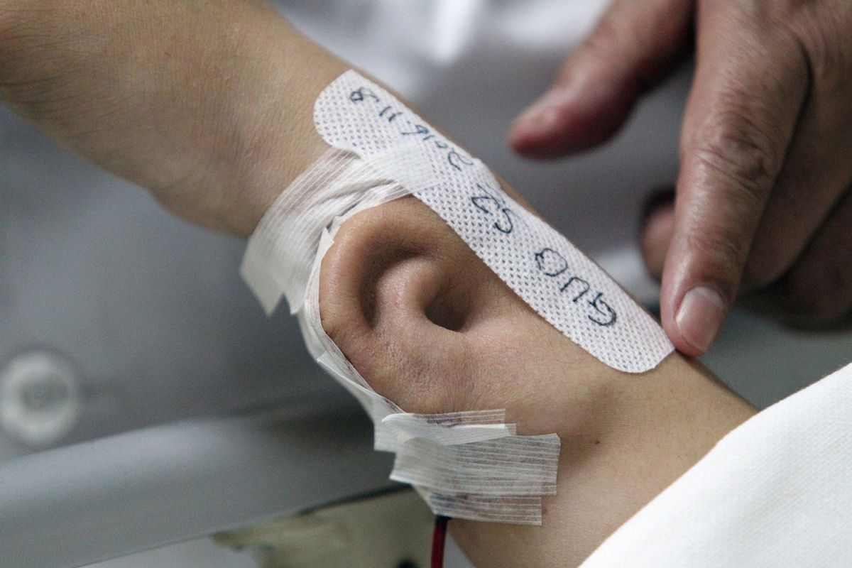 Orelha é cultivada no braço de um paciente na China